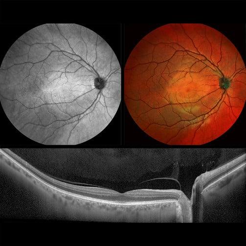 retina